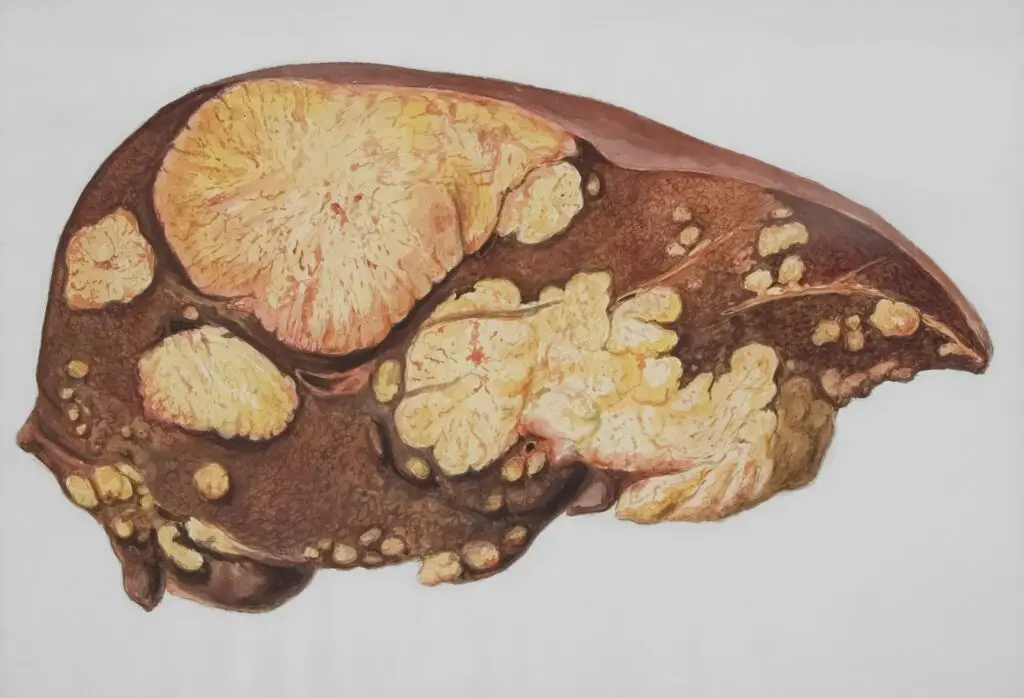 Fatty liver awareness